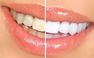Veneers - Kosmetische Zahnheilkunde